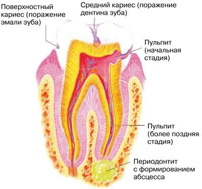 Кариес и его осложнения 3 oslozhnennyj karies